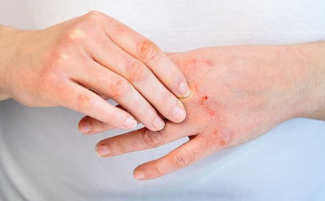 乳膠手套能否有效防止長(zhǎng)水泡？